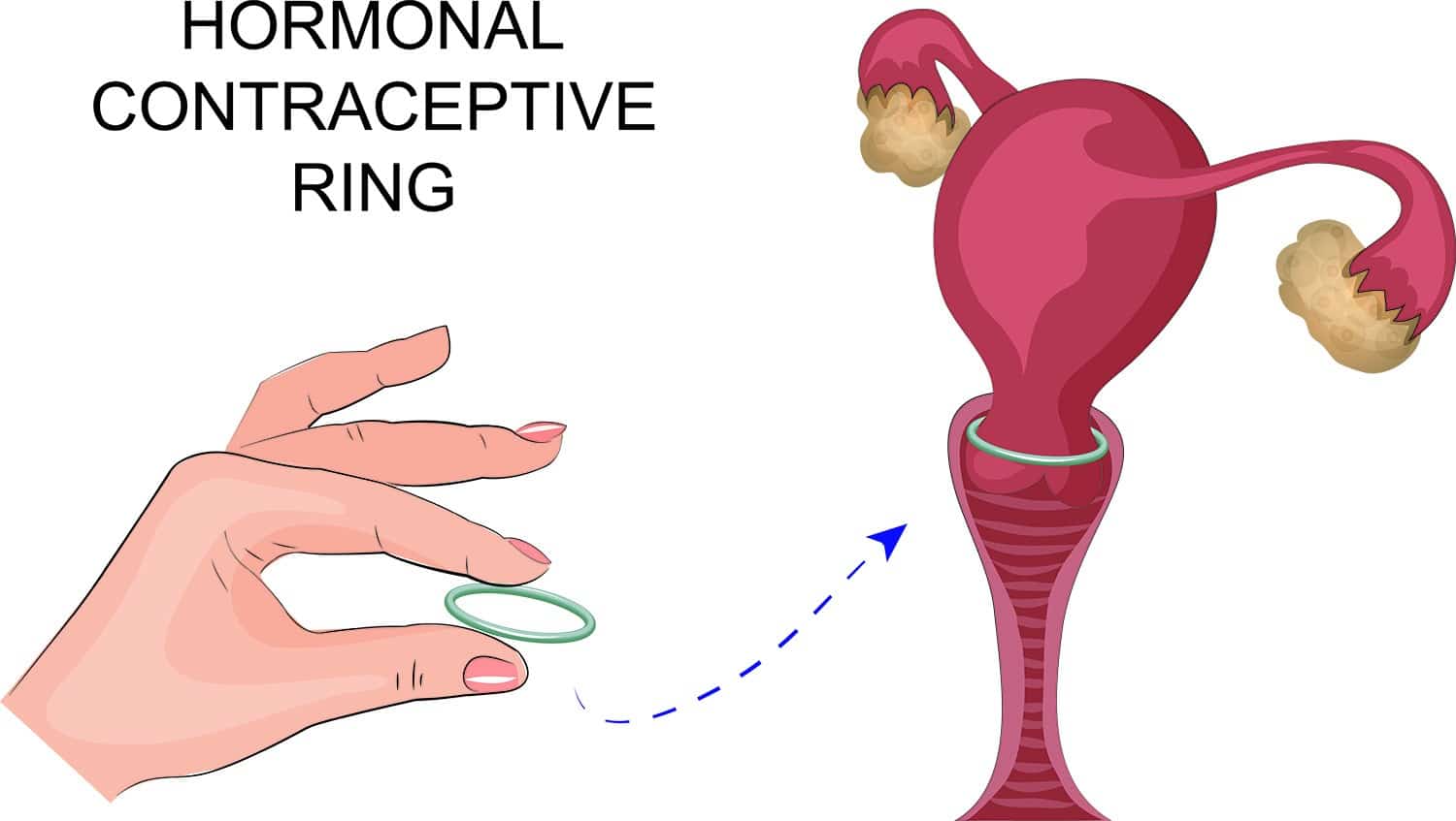 Contraception en voyage - L'anneau vaginale